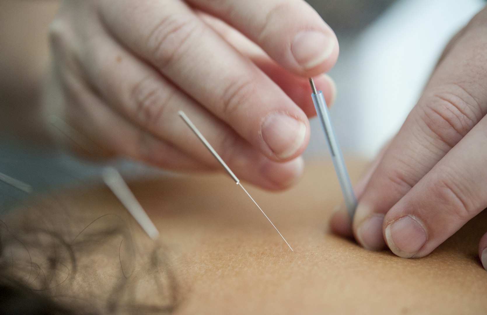 Acupuncture pour réduire le stress et améliorer le sommeil